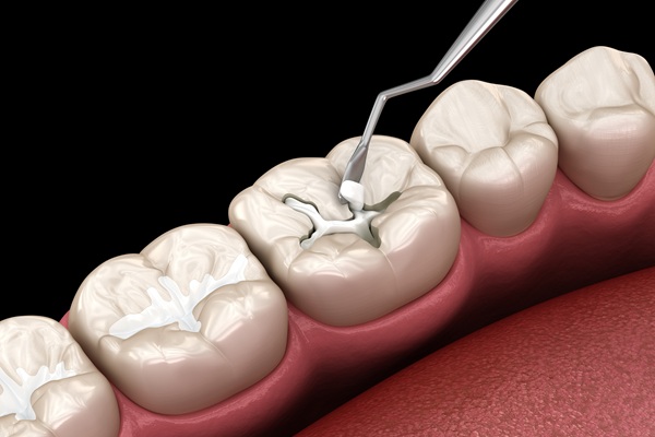 Choosing The Right Tooth Filling For You